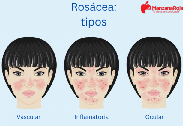 Rosácea: Conoce sus causas, factores de riesgo y tratamientos efectivos
